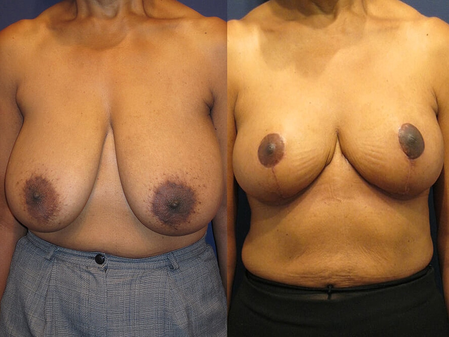 Before and after images of breast procedure.