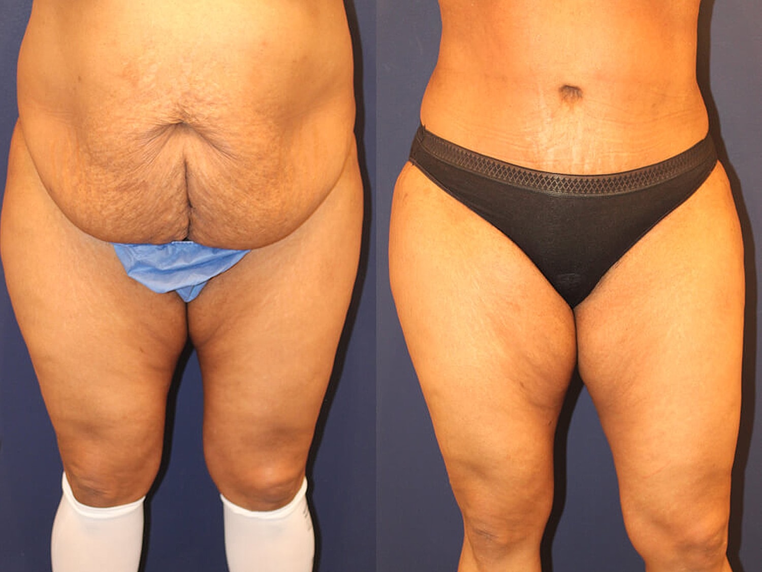 Body transformation before and after surgery.