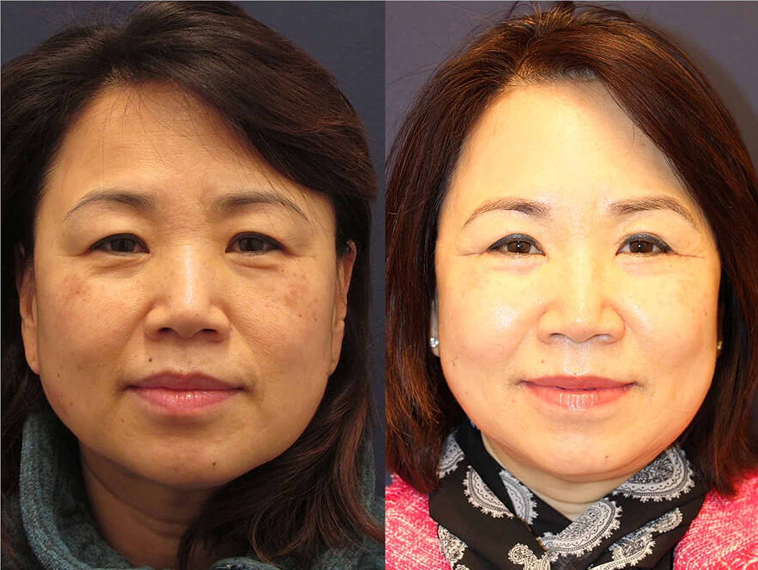 Before and after facial rejuvenation treatment comparison.