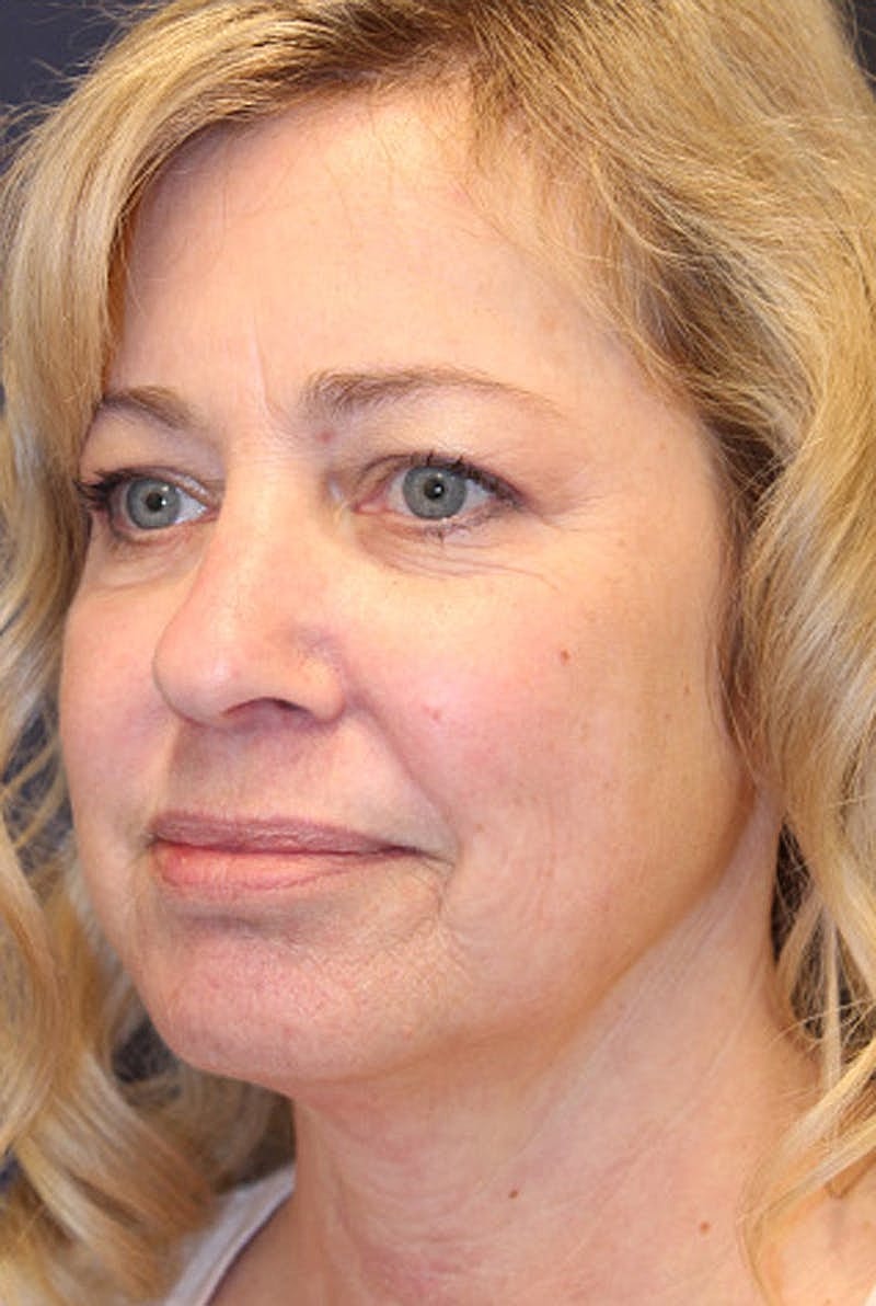 Facial Fat Graft Before & After