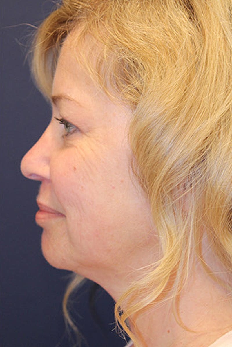 Facial Fat Graft Before & After