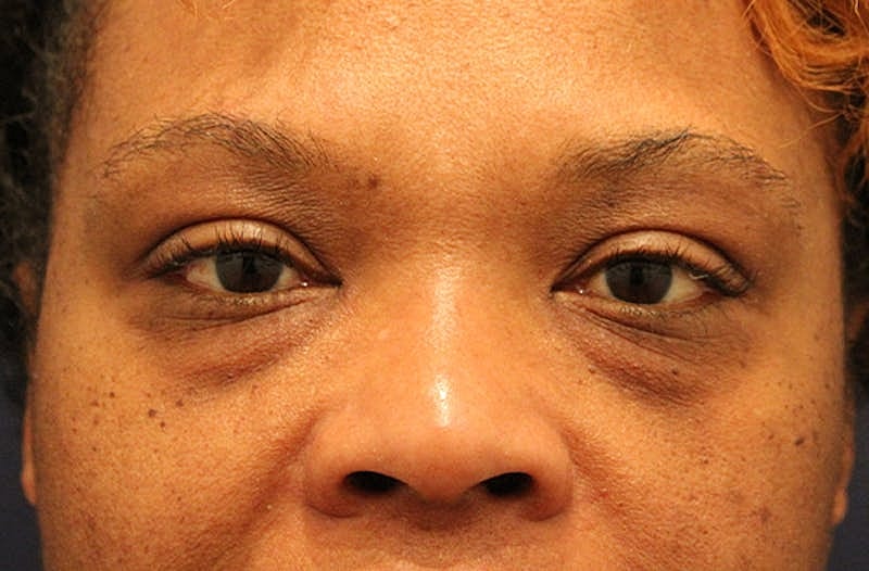 Facial Fat Graft Before & After