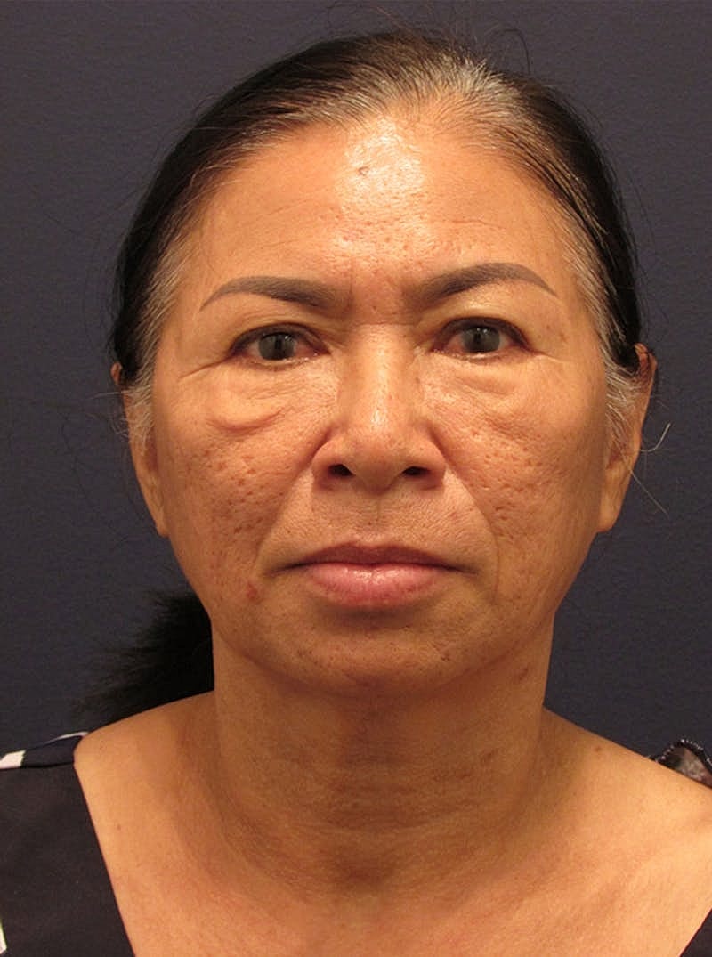 Facial Fat Graft Before & After