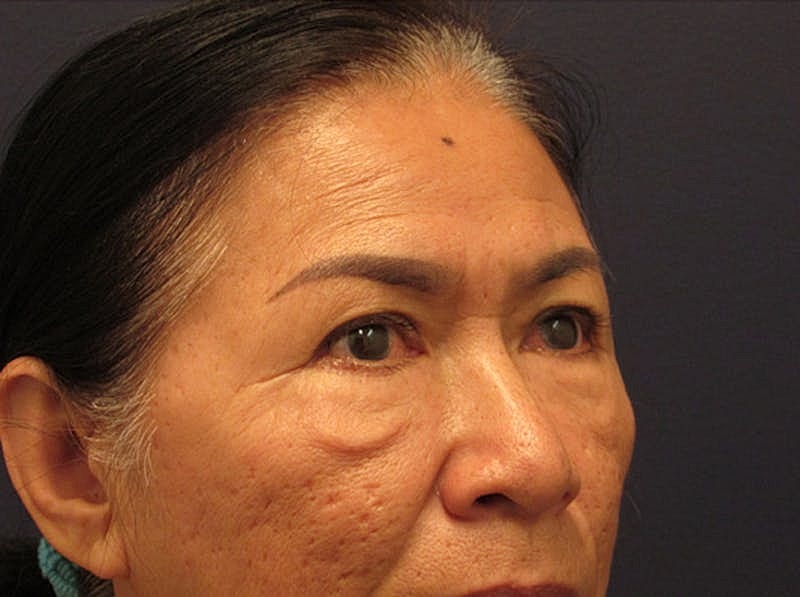 Facial Fat Graft Before & After
