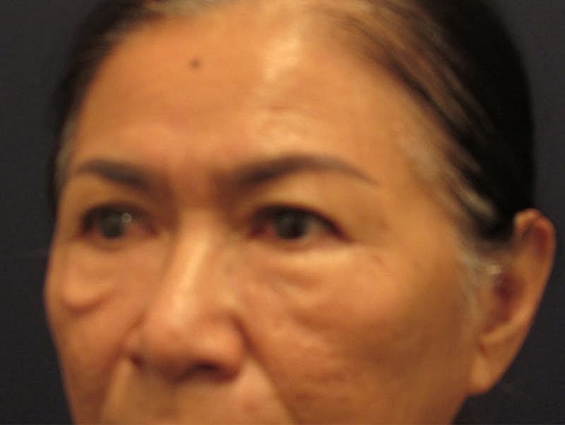 Facial Fat Graft Before & After