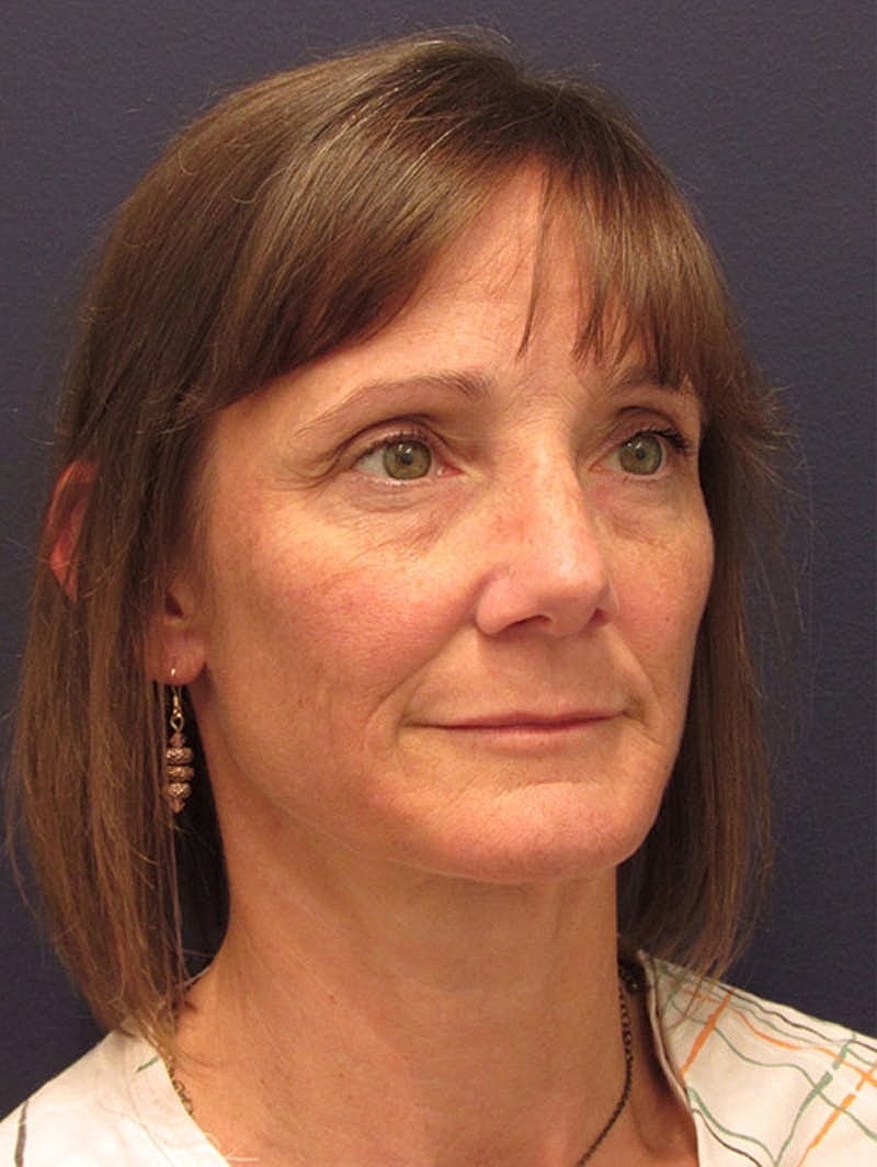 Facial Fat Graft Before & After