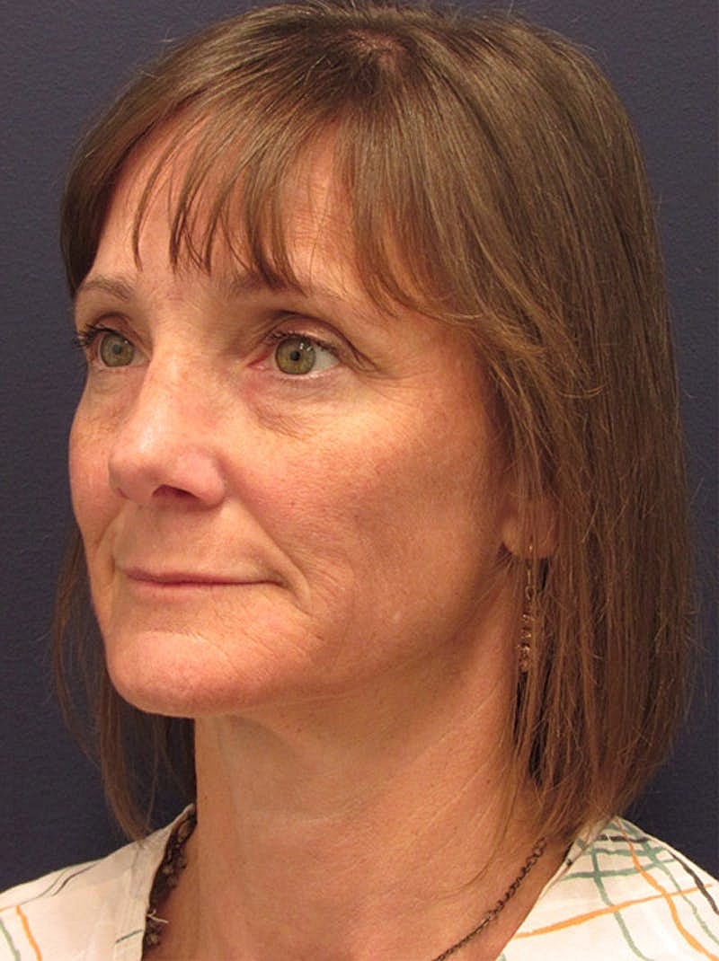 Facial Fat Graft Before & After