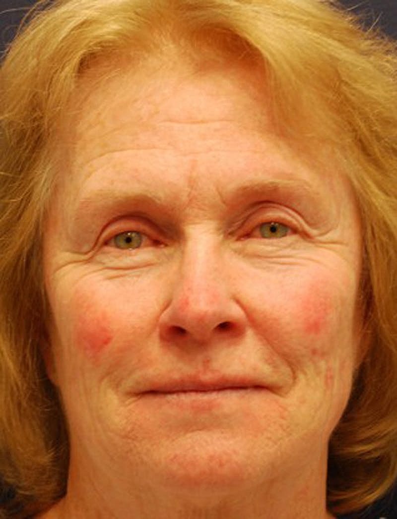 Facial Fat Graft Before & After