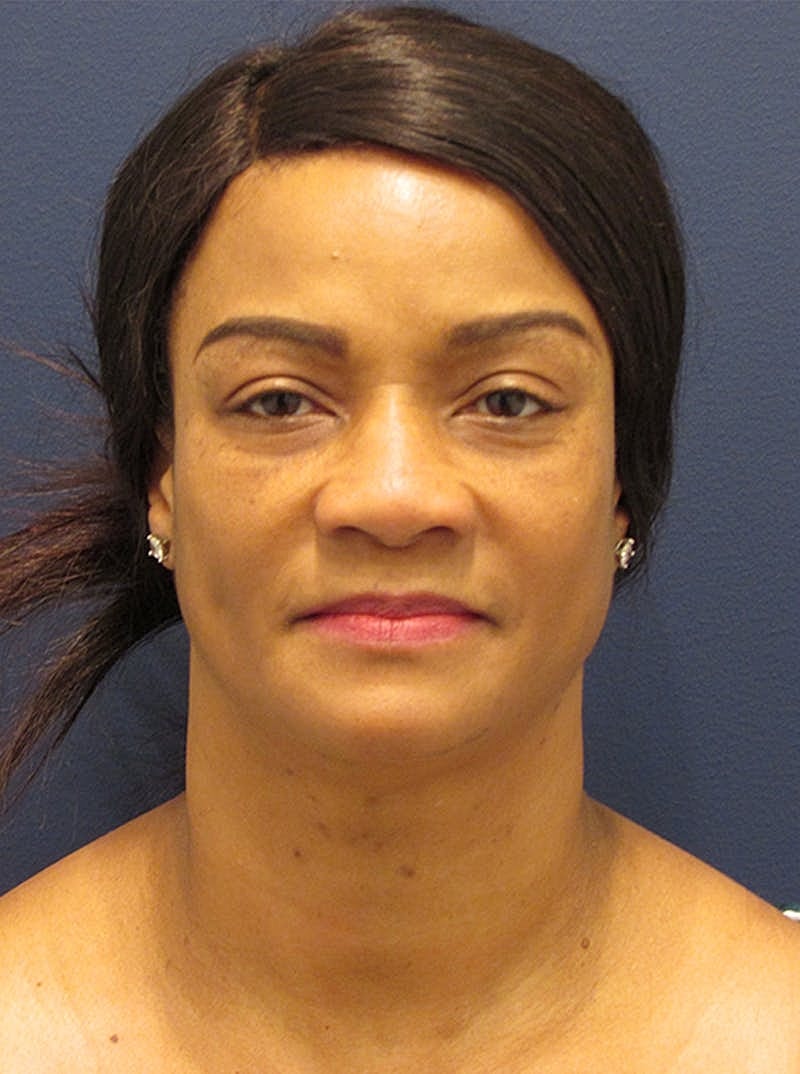 Facial Fat Graft Before & After