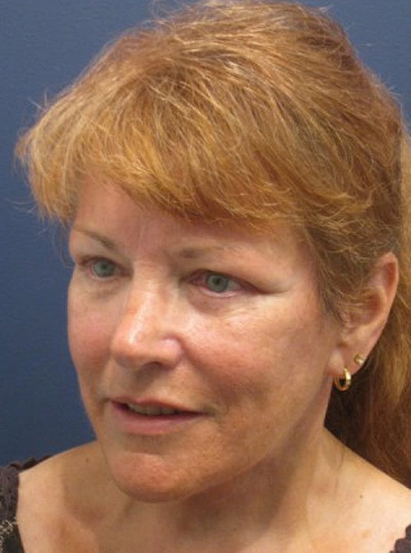 Facial Fat Graft Before & After