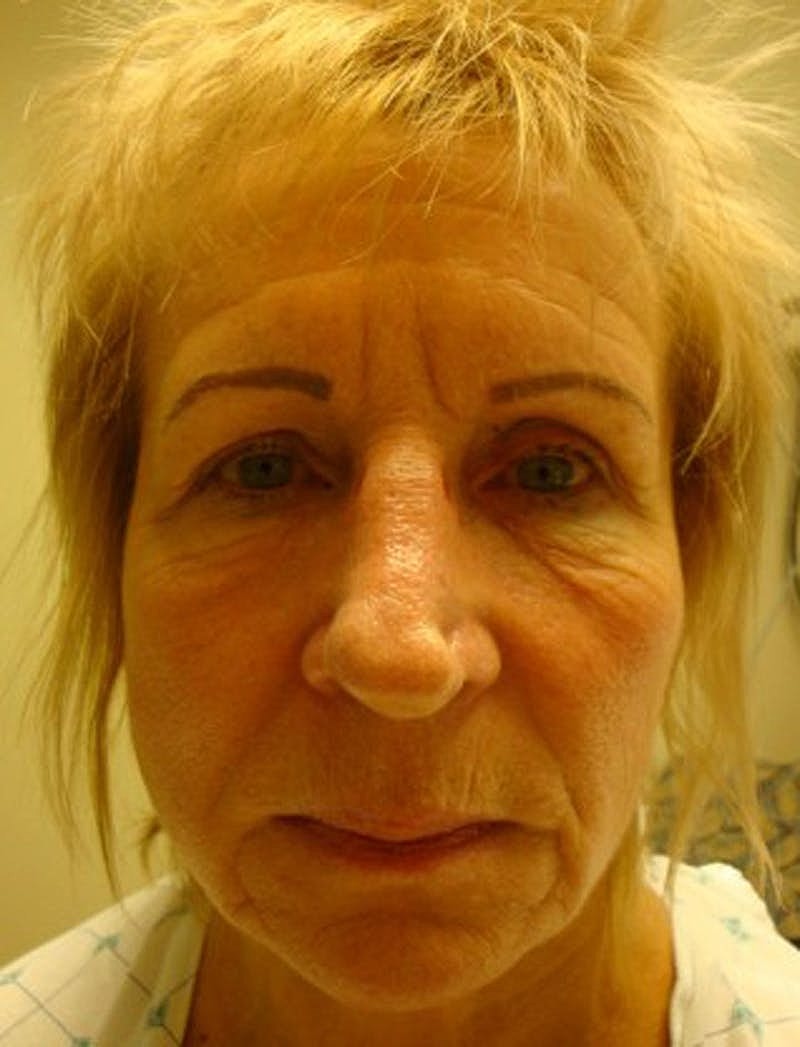 Facial Fat Graft Before & After