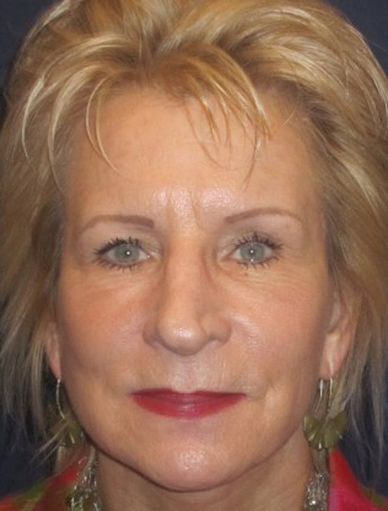 Facial Fat Graft Before & After