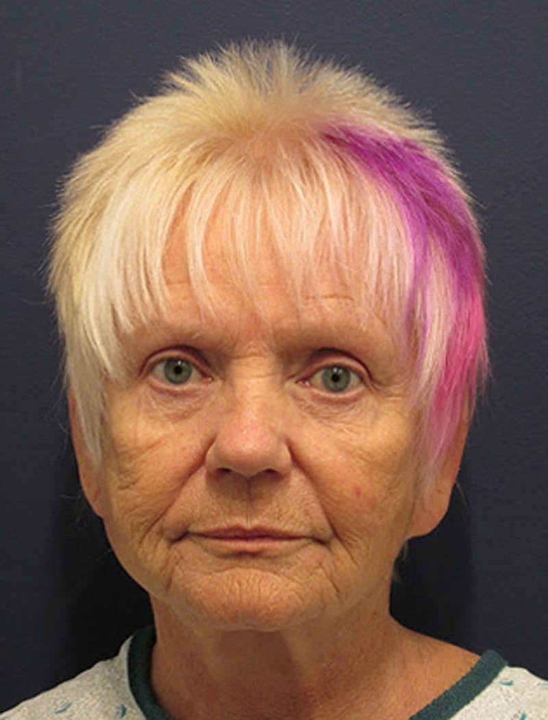 Facial Fat Graft Before & After