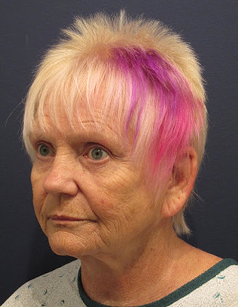 Facial Fat Graft Before & After