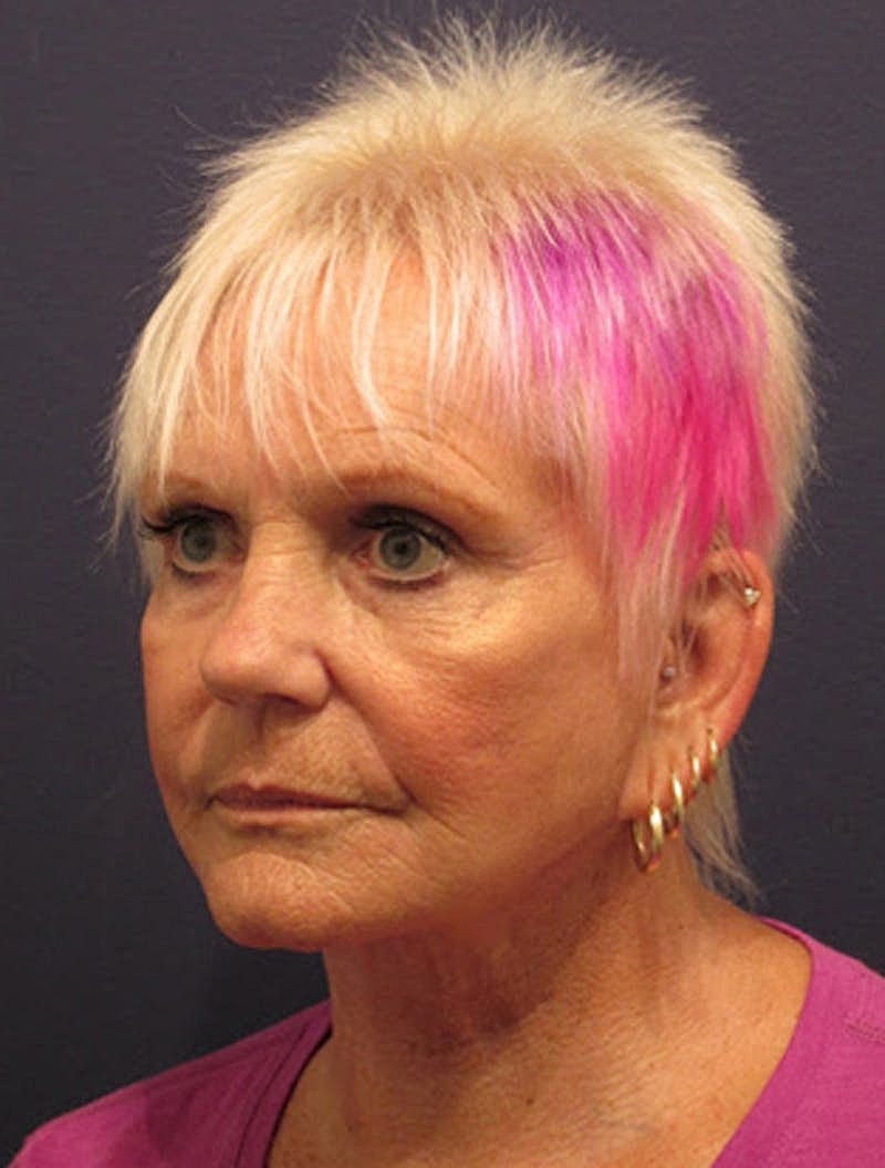 Facial Fat Graft Before & After