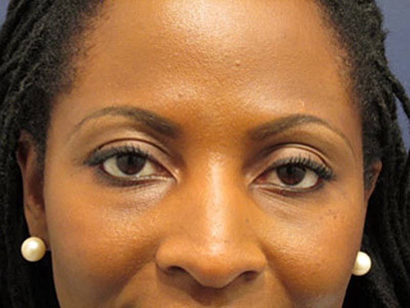 Facial Fat Graft Before & After