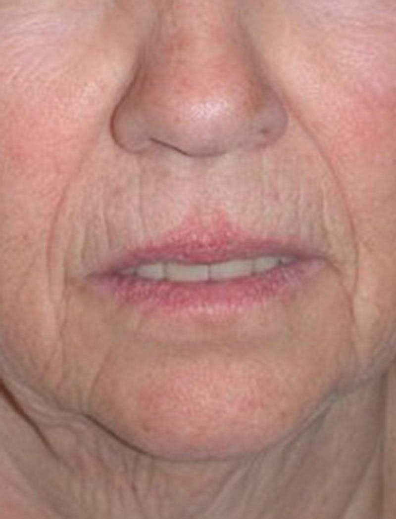Facial Fat Graft Before & After