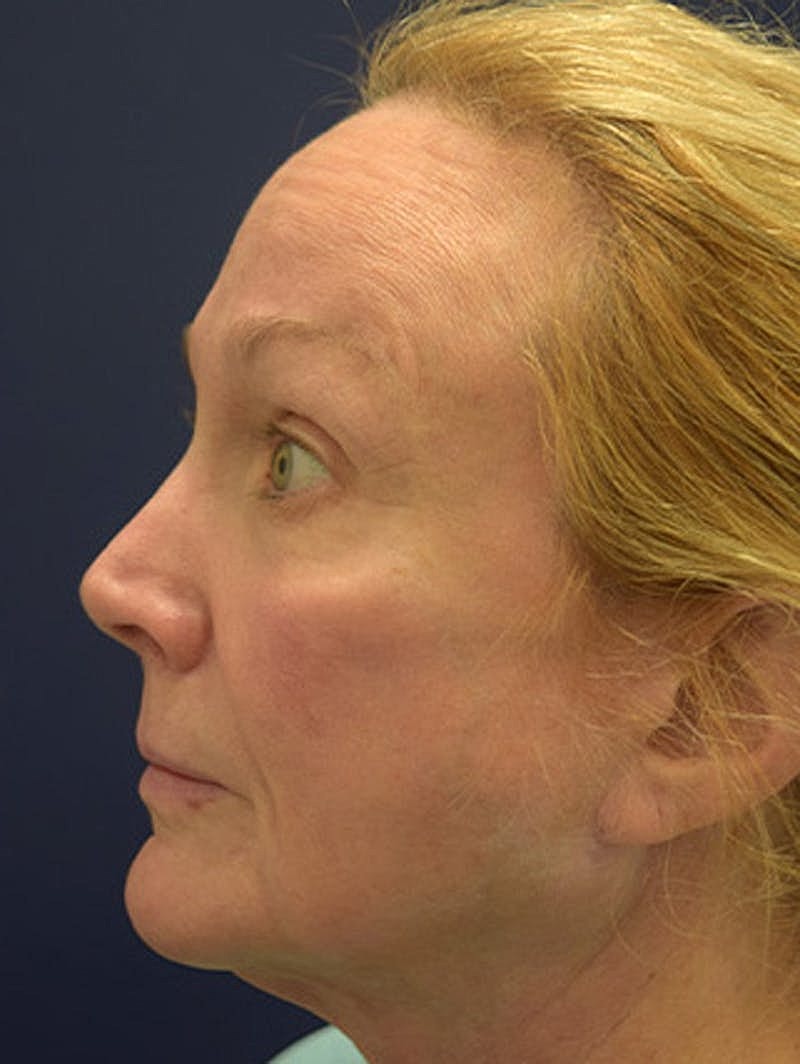 Facial Fat Graft Before & After