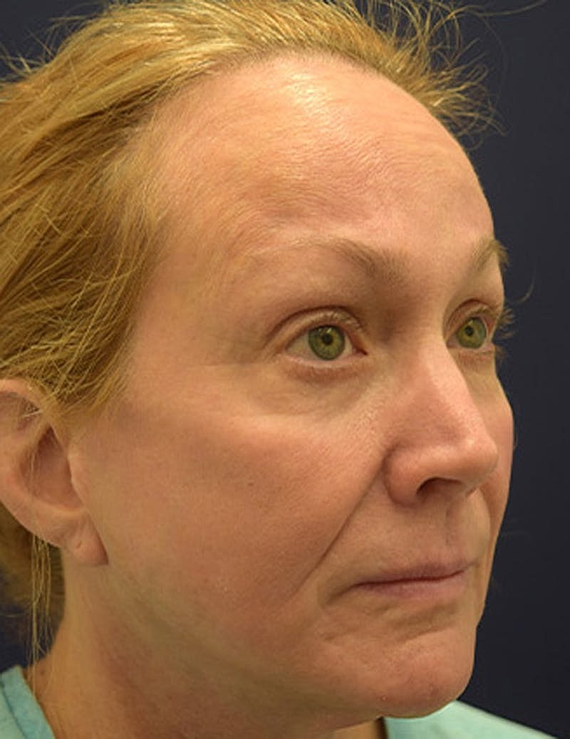 Facial Fat Graft Before & After