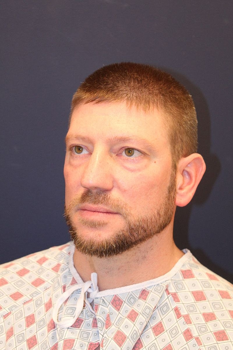 Facial Fat Graft Gallery Before & After
