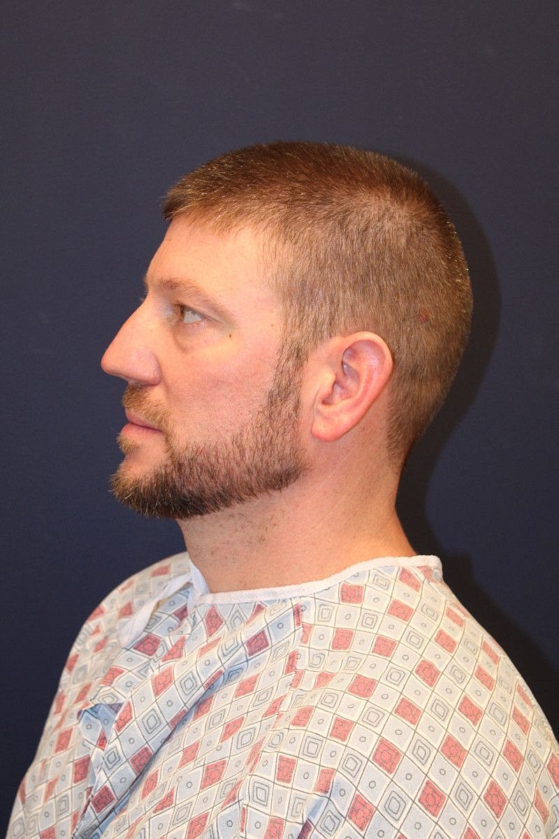 Facial Fat Graft Gallery Before & After