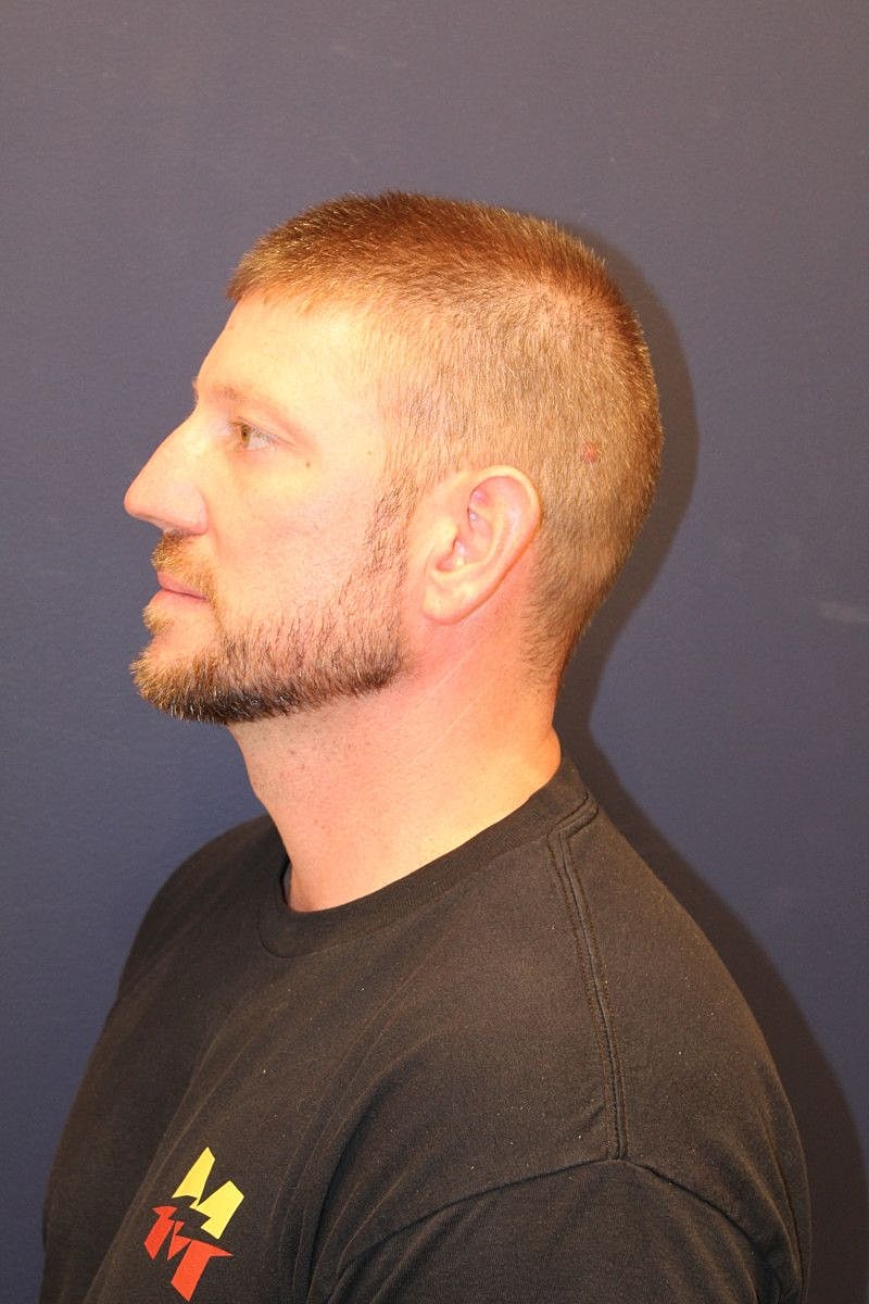 Facial Fat Graft Gallery Before & After