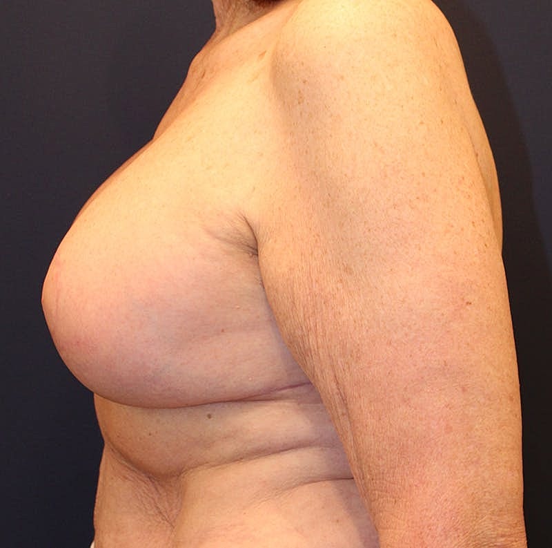 Breast Lift Before & After