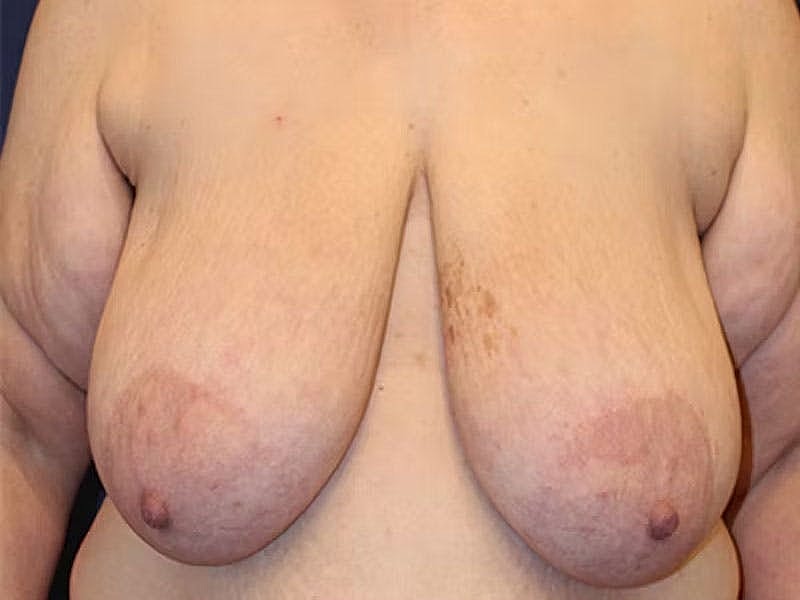 Breast Lift Before & After