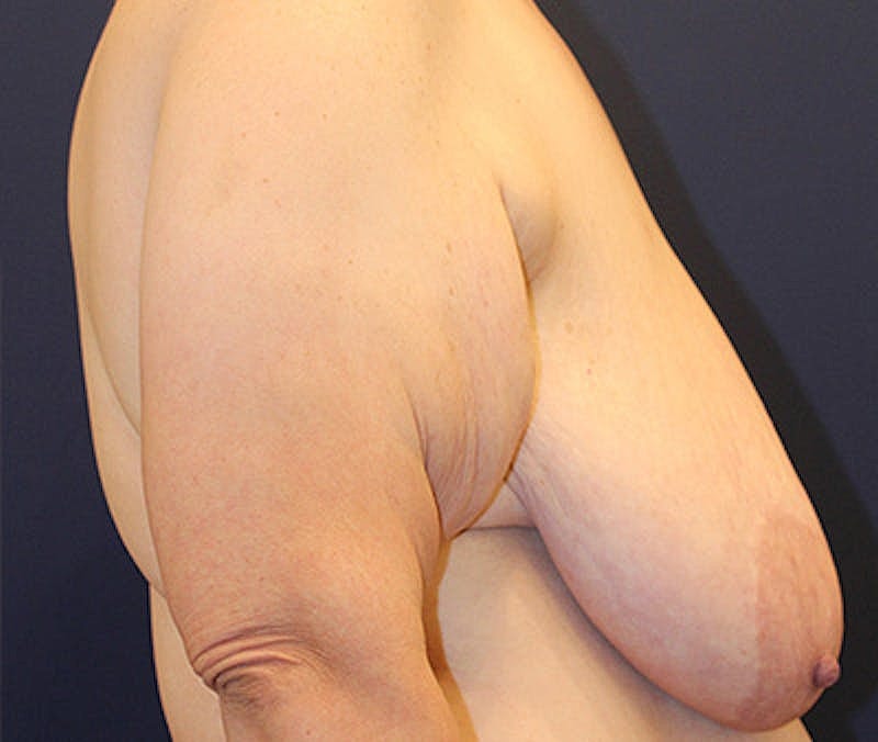 Breast Lift Before & After