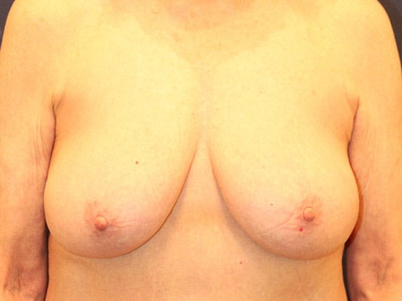 Breast Lift Before & After
