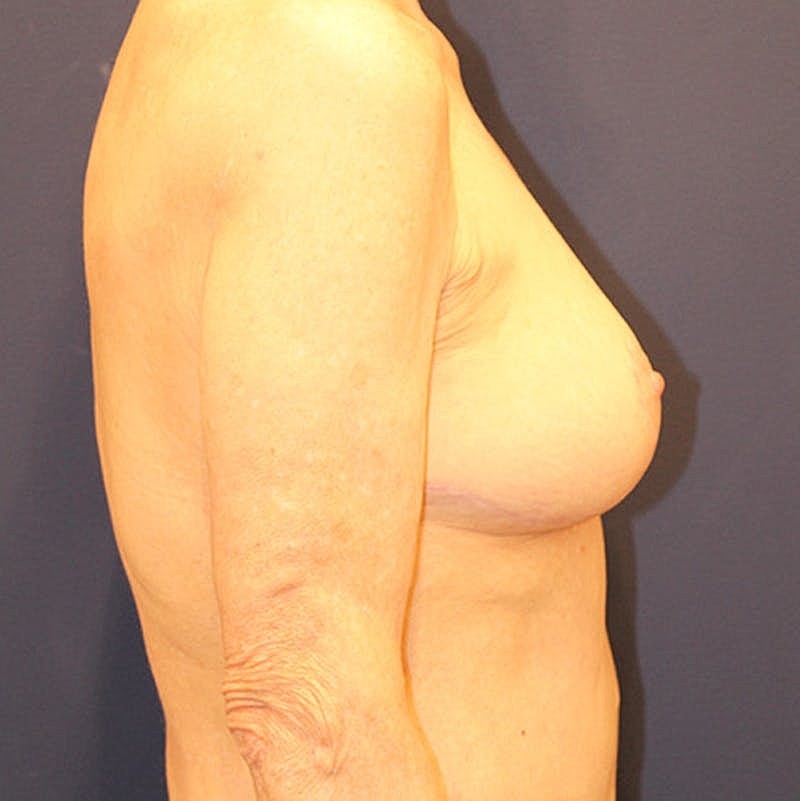 Breast Lift Before & After