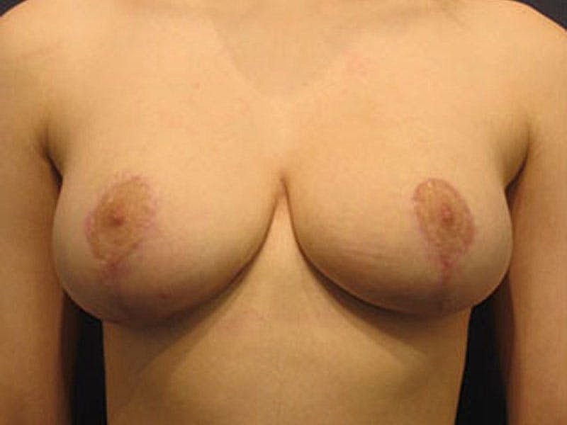 Breast Lift Before & After