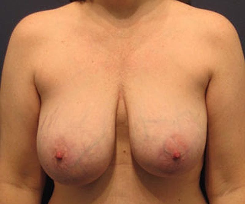 Breast Lift Before & After