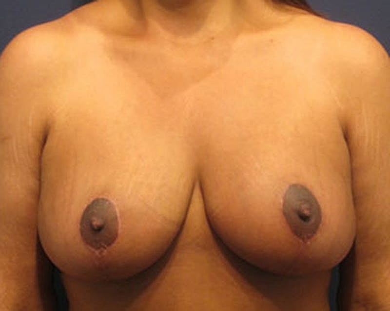 Breast Lift Before & After
