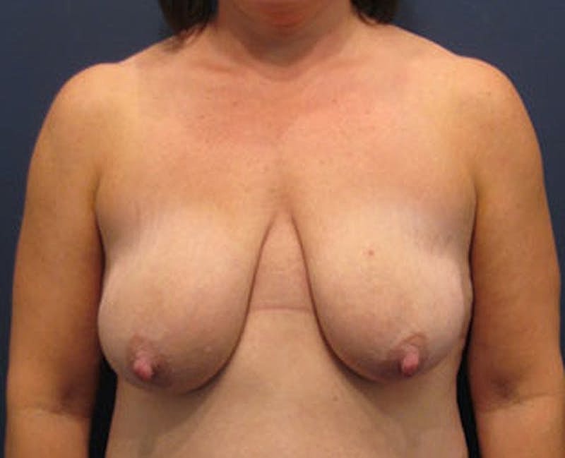 Breast Lift Before & After