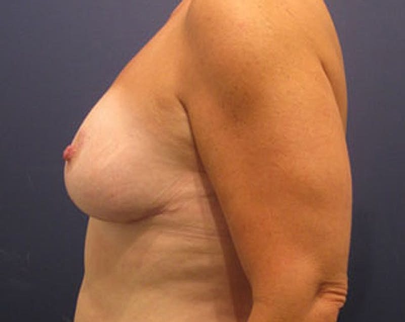 Breast Lift Before & After
