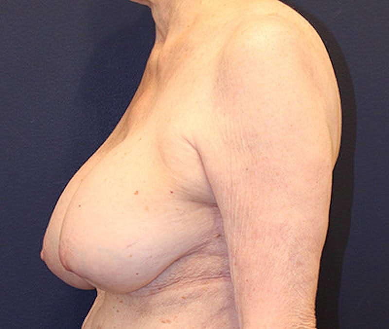 Breast Lift Before & After