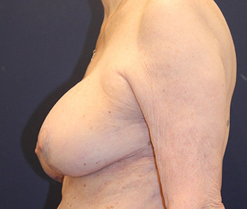 Breast Lift Before & After