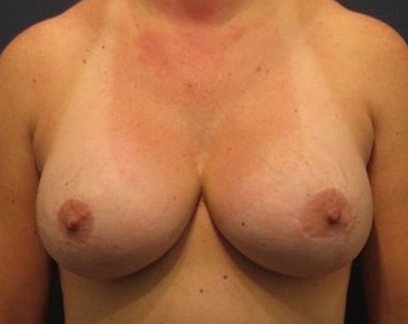 Breast Lift Before & After