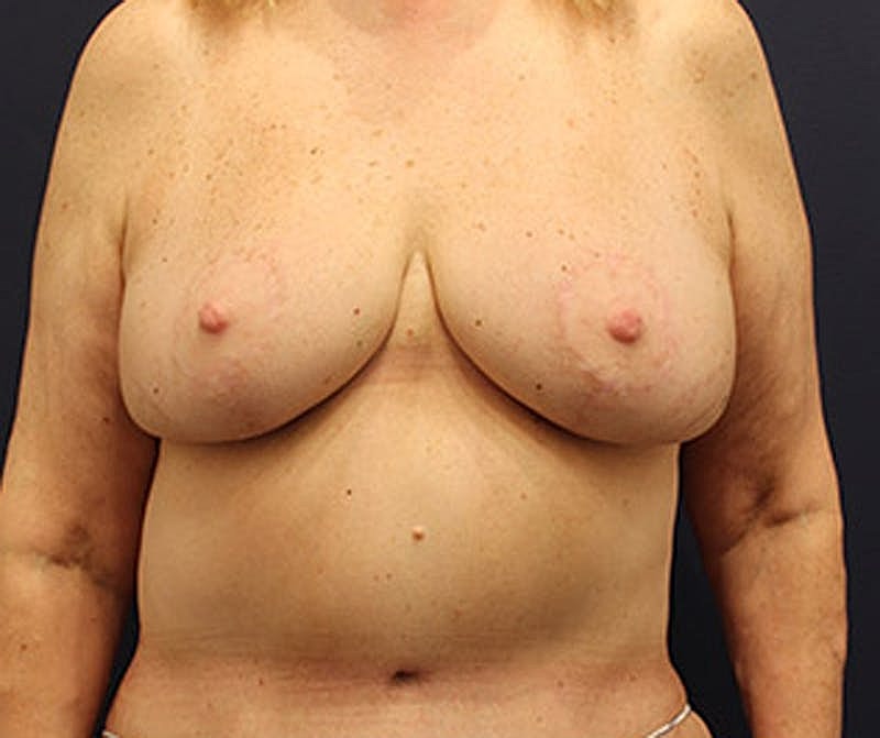 Breast Lift Before & After