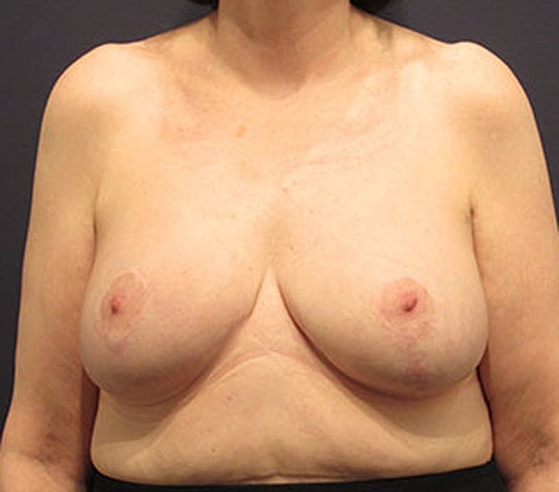Breast Lift Before & After