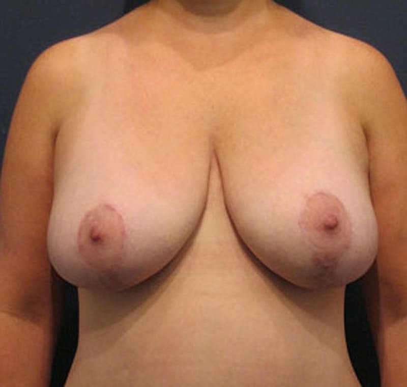 Breast Lift Before & After