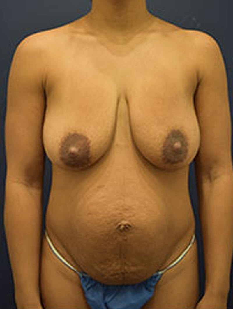 Breast Lift Before & After