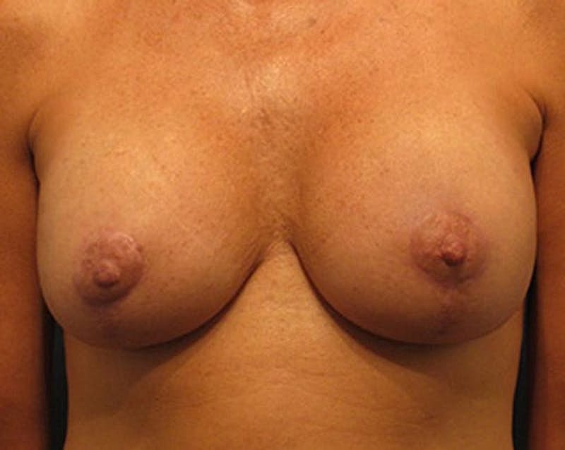 Breast Lift Before & After