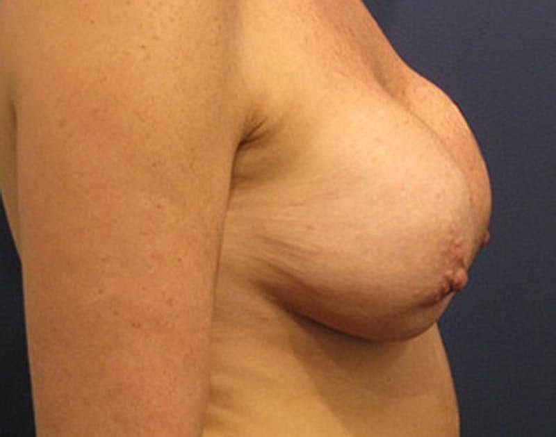 Breast Lift Before & After