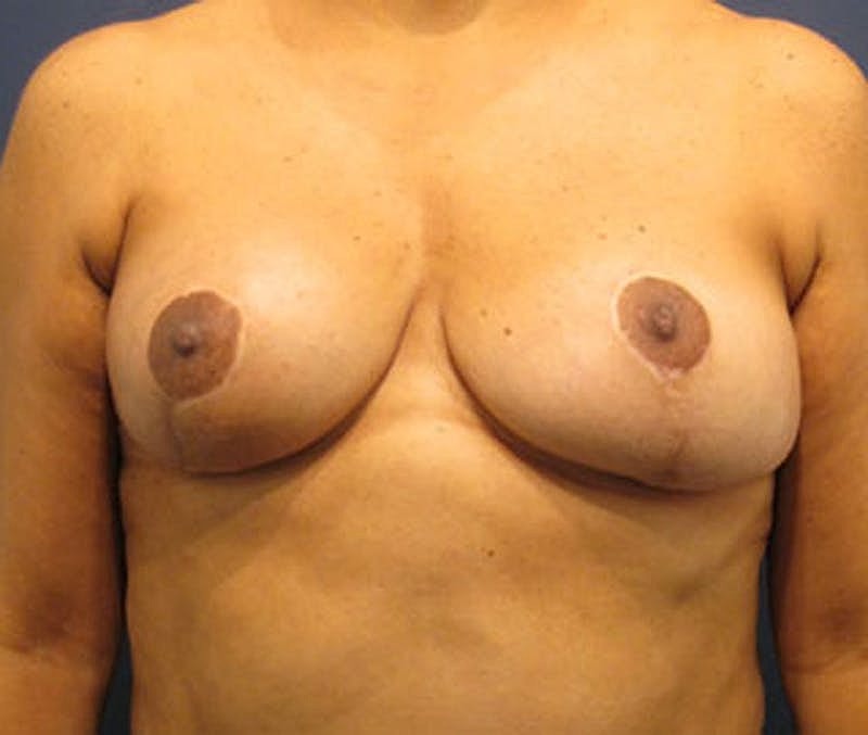 Breast Lift Before & After