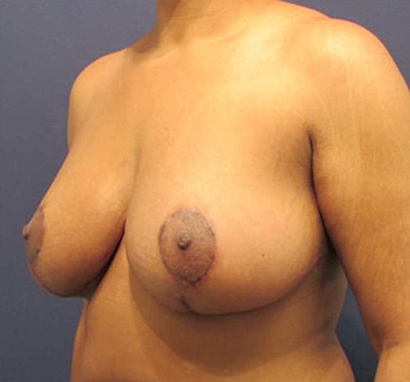 Breast Lift Before & After