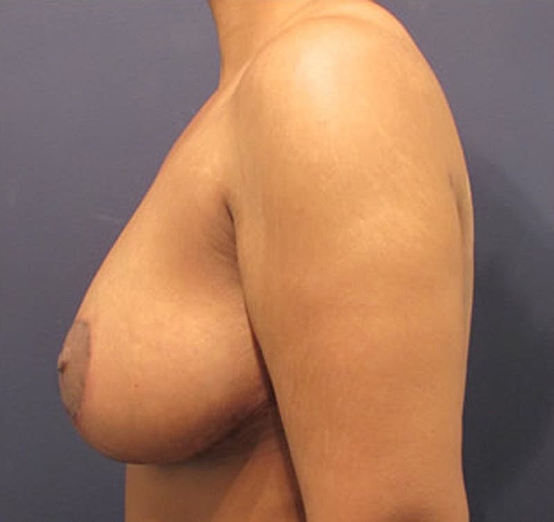 Breast Lift Before & After