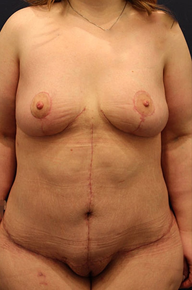 Breast Lift Before & After
