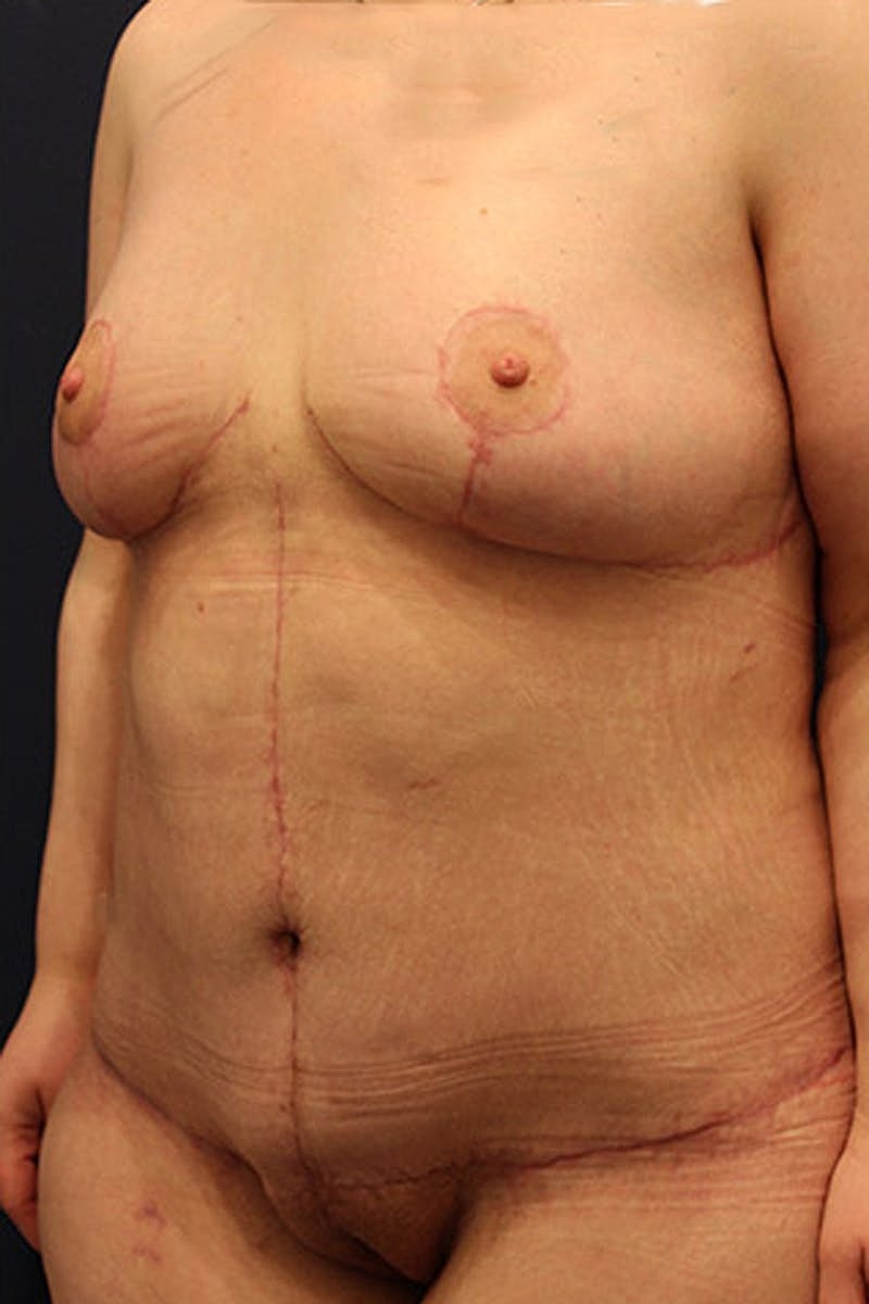 Breast Lift Before & After